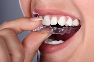Step 3 - Clear Aligners